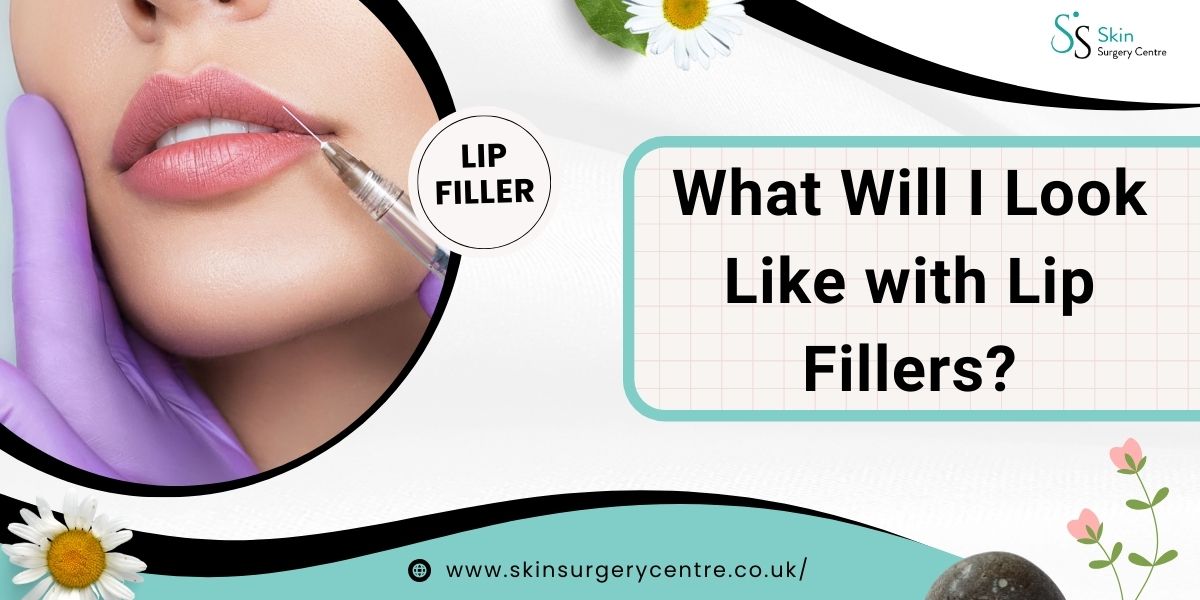 What Will I Look Like with Lip Fillers?