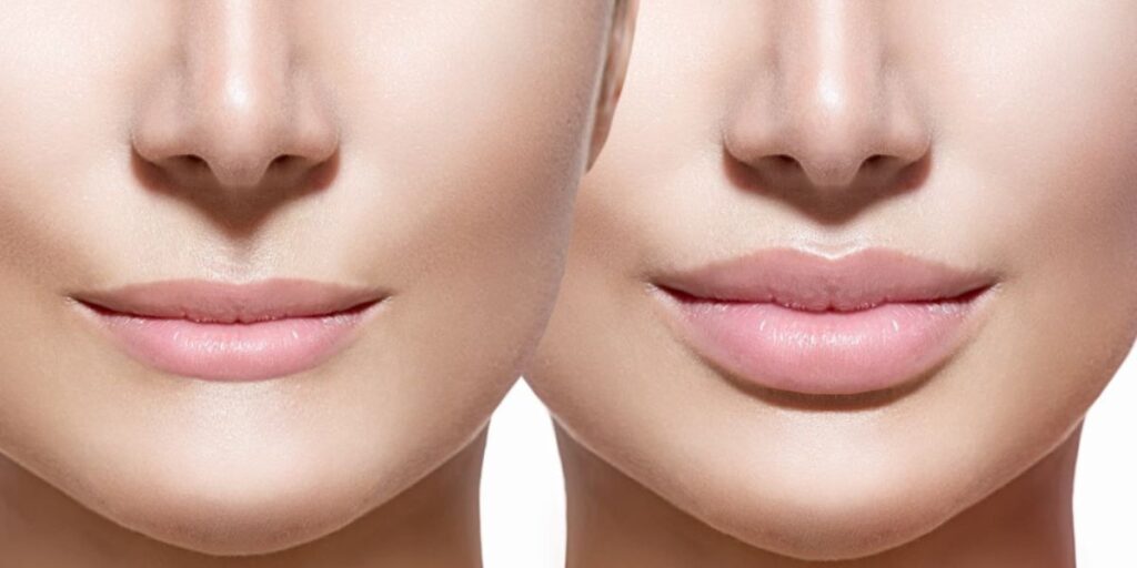 Lip Filler Natural-Looking Results 