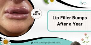 Lip Filler Bumps After a Year