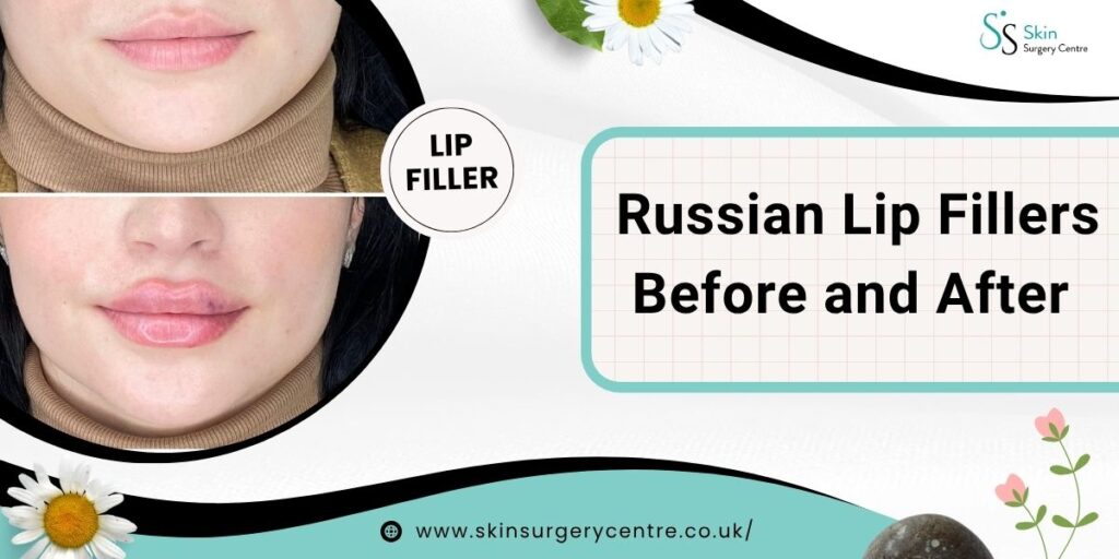 Russian Lip Fillers Before and After | Benefits, Results & Safety Guide