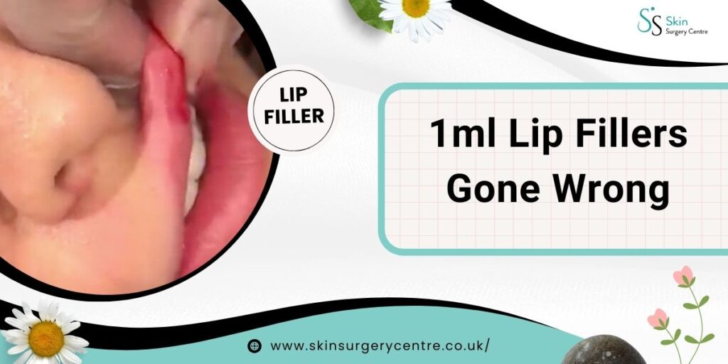 1ml Lip Fillers Gone Wrong – Risks & Safe Recovery