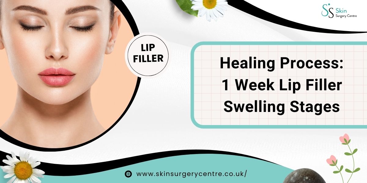 Healing Process: 1 Week Lip Filler Swelling Stages