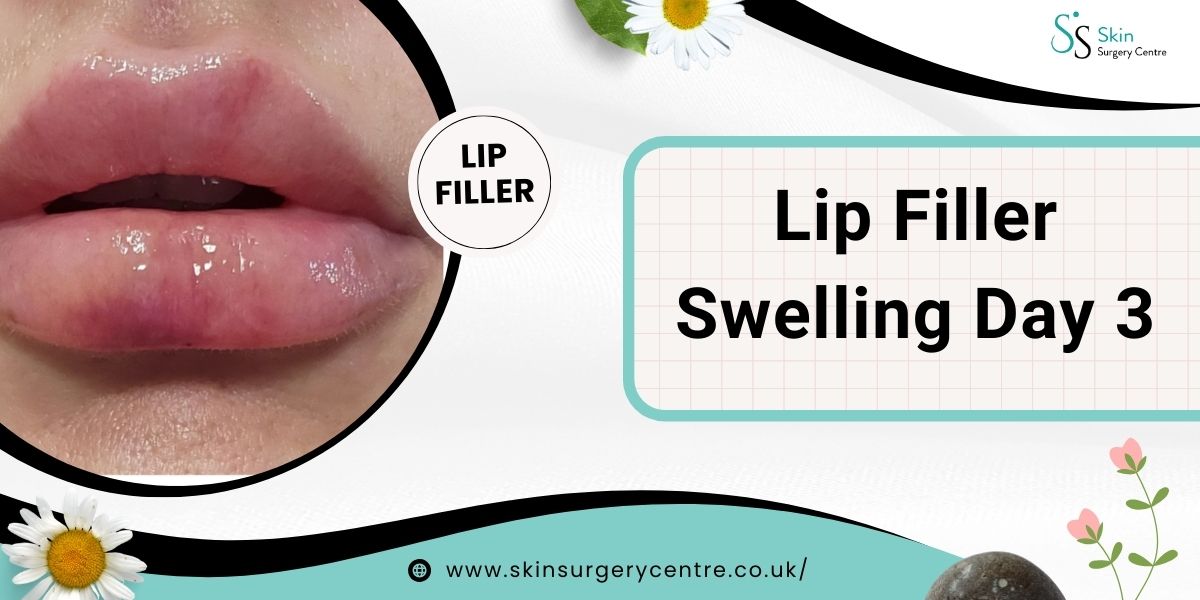 Lip Filler Swelling Day 3