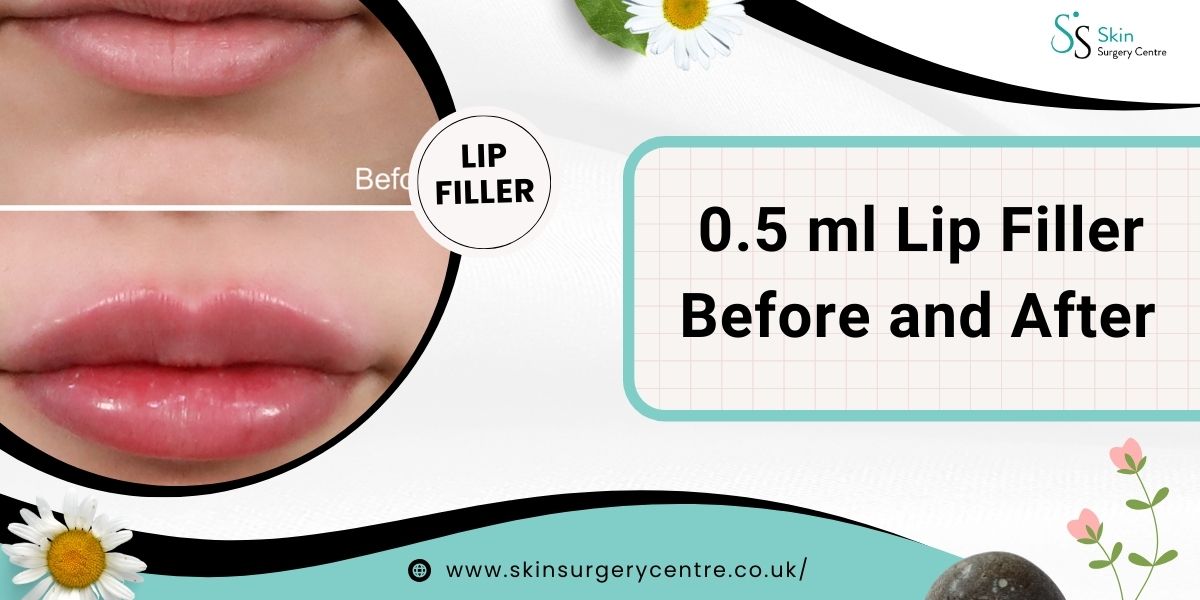 0.5 ml Lip Fillers Before and After