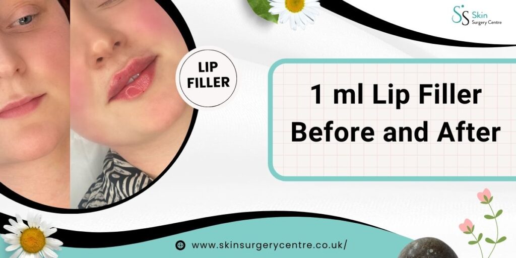 1 ml Lip Filler Before and After Pictures: All Important Details
