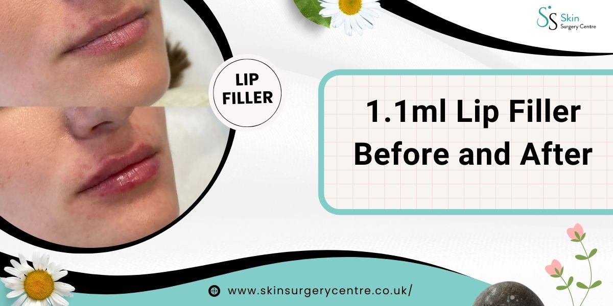 1.1 ml Lip Filler Before and After