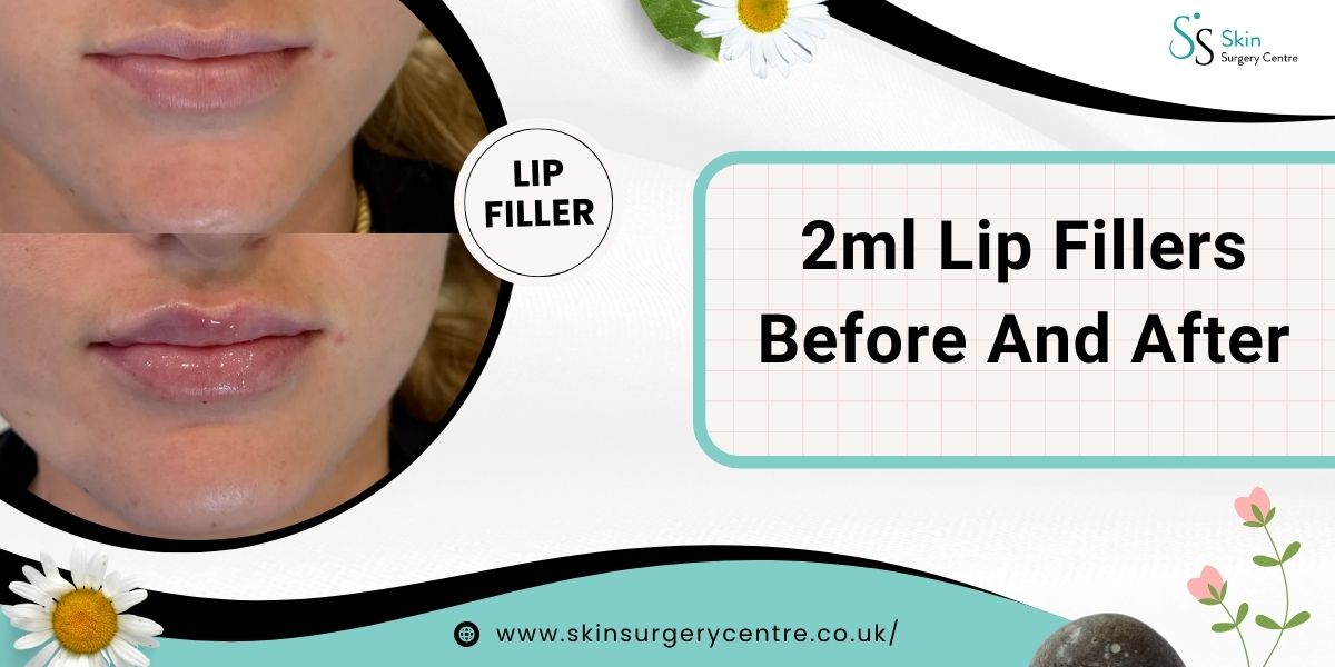 2ml Lip Fillers Before And After
