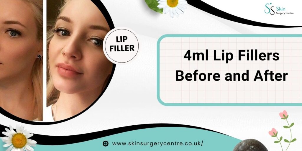 4ml Lip Fillers Before and After Photos – Important Information to Consider