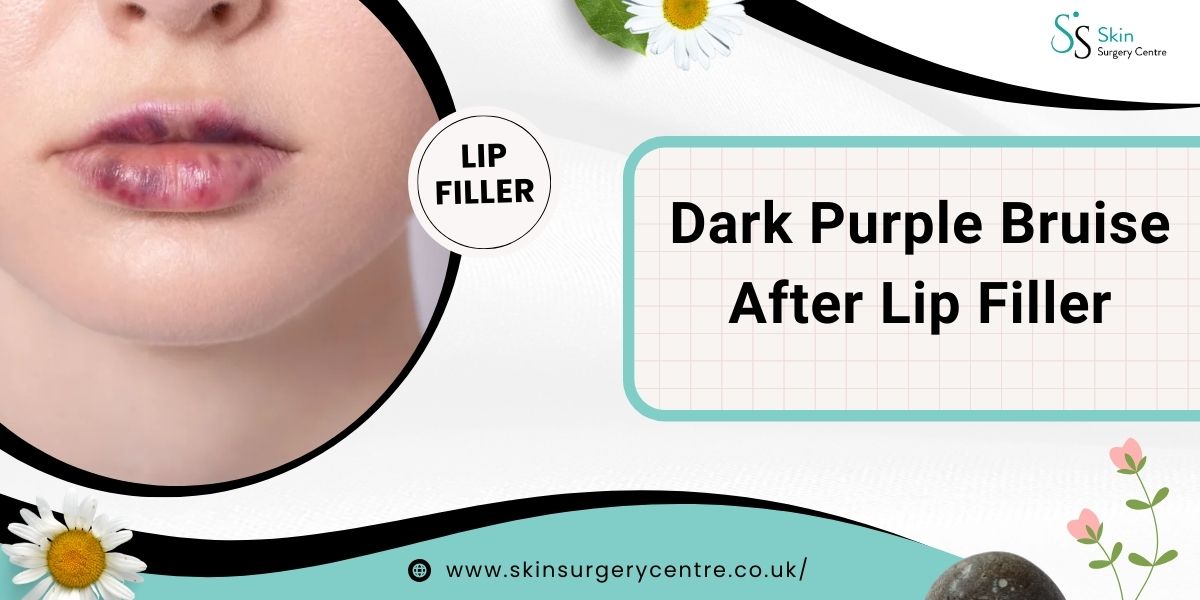 Dark Purple Bruise After Lip Filler