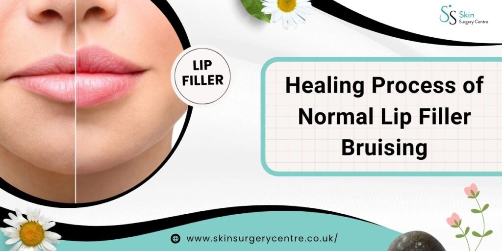 Healing Process of Normal Lip Filler Bruising – What to Expect?