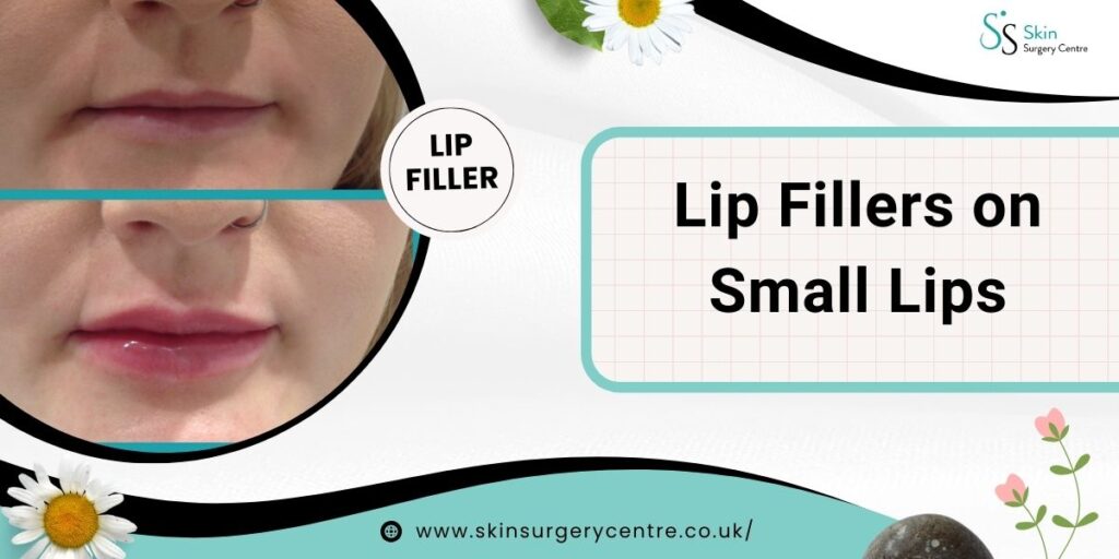 Lip Fillers for Small Lips: Everything You Need to Know