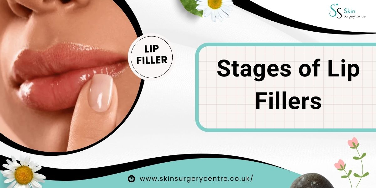 Stages of Lip Fillers