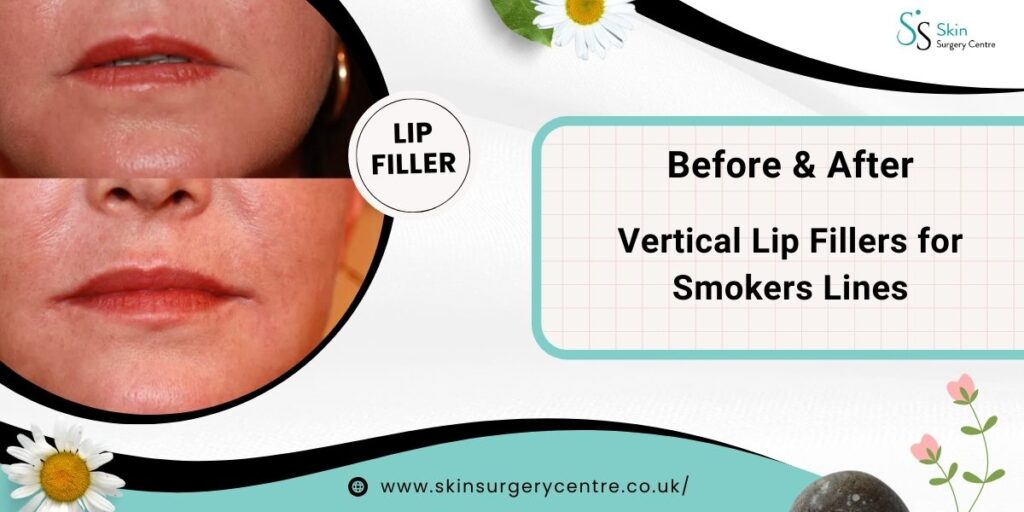 Vertical Lip Fillers for Smokers Lines – Before & After Results