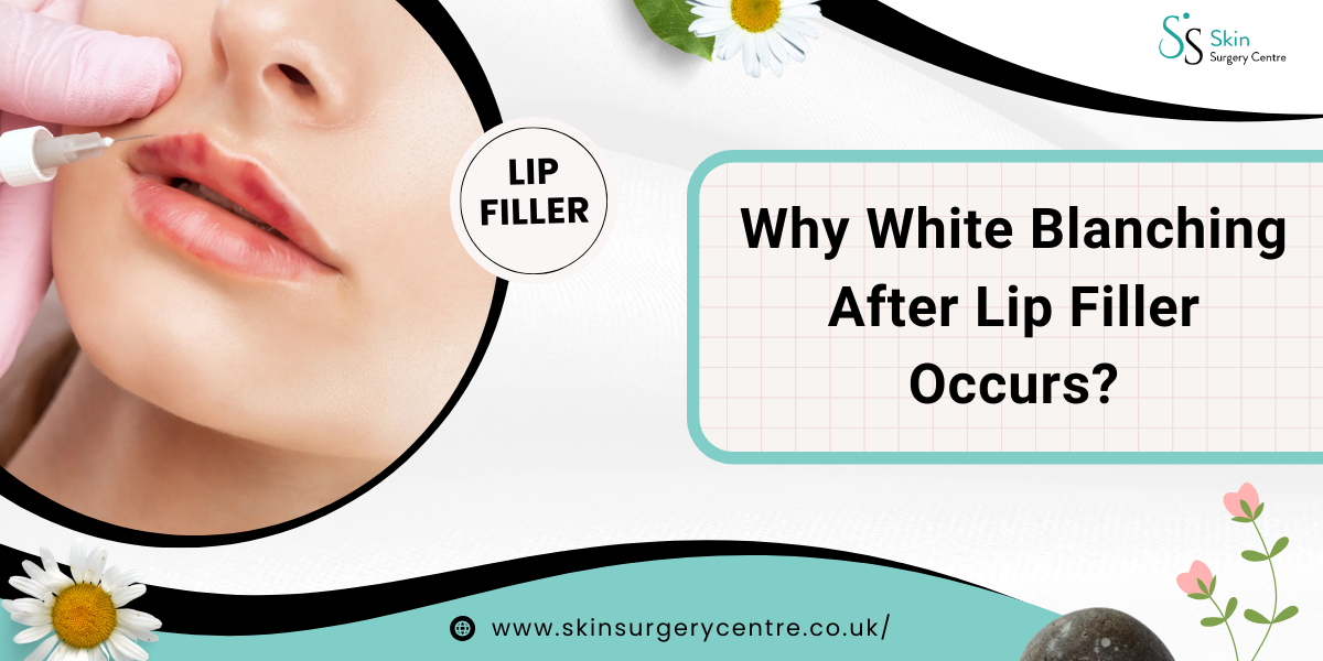 Why White Blanching After Lip Filler Occurs
