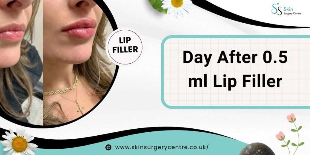 What to Expect Day After 0.5 ml Lip Filler?